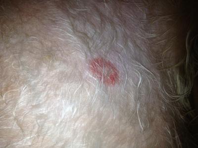 Half-dollar sized rash with flat, round red-patch and white center