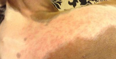 Rash Underside more Chest Area