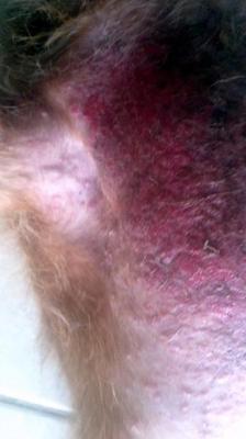 Underarm Rash
