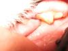 Left side of mouth 2