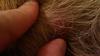 Raised Skin, Almost a Scab